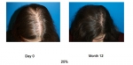 ACell + PRP Hair Regrowth Therapy - NYC