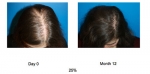 ACell + PRP Hair Regrowth Therapy