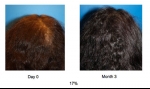 ACell + PRP Hair ReGrowth Therapy