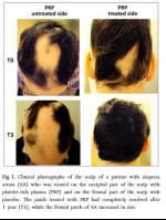 AWESOME PRP Hair Regrowth Therapy With Acell