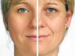 Bio Facials Can Replace Plastic Surgery