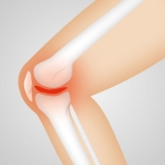 Knee Osteoarthritis Treatment - Non-Surgical Stem Cells