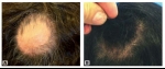 PRP Hair Restoration Treatment With ACell