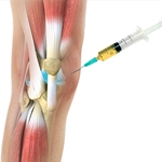 PRP treatments benefits for osteoarthritis.