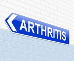 Reduce Arthritis Pain - Stem Cell Injection