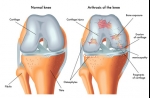 Stem Cells For Arthritis