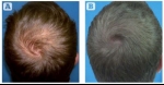 Stop Hair Loss With ACell + Platelet Rich Plasma Hair Therapy