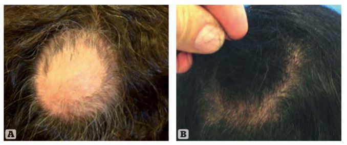 PRP Hair Restoration Treatment With ACell