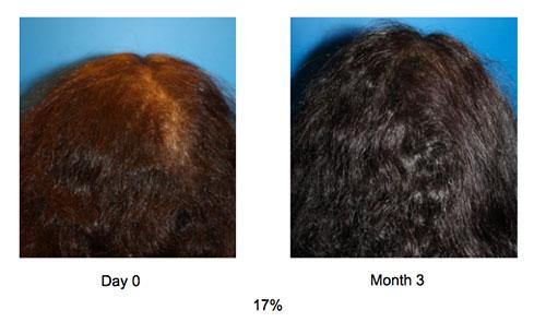 ACell Hair Regrowth