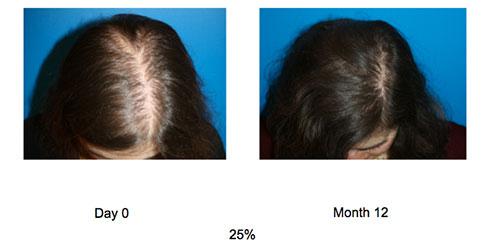 Photographs of Hair Restoration