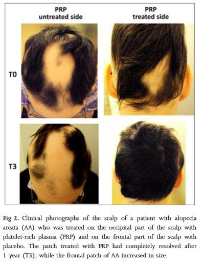 Photographs of Hair Restoration