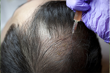 PRP Therapy for Hair Loss