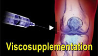 Joint Fluid Replacement Viscosupplementation